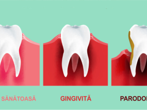 (P) Clinica DENTAL PRIME Pitești: Ai gingii inflamate? Află dacă este gingivită sau parodontită